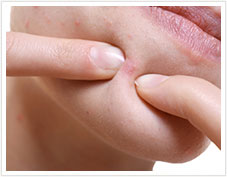 顎 あご ニキビがひどいときの原因と適切なスキンケア 公式 ニキビケア化粧品のプロアクティブ