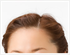 医師監修 髪の生え際や頭皮ニキビの原因とケア 公式 ニキビケア化粧品のプロアクティブ